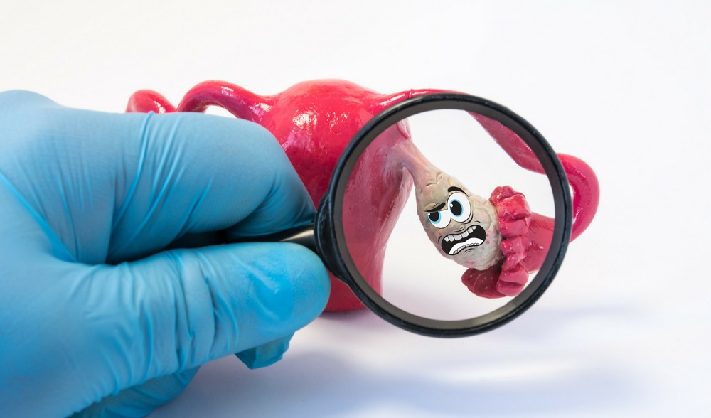 PCOS Treatment: A Guide to Managing Polycystic Ovary Syndrome